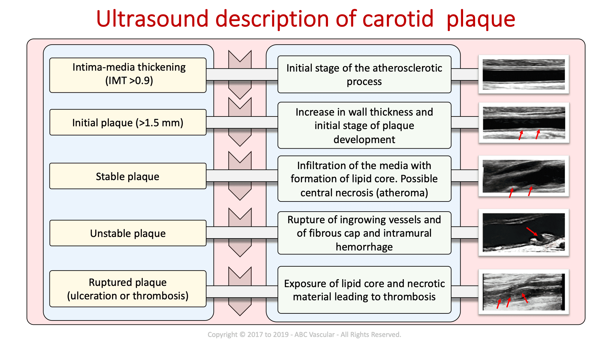 Carotid Course Info | Abc Vascular Intended For Carotid Ultrasound Report Template